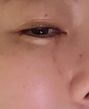 2026년 4월 6일 안방 천장 마감재가 떨어진 사고 뒤 촬영한 눈 아래 부위. 김씨는 떨어진 벽지가 얼굴을 스치며 오른쪽 눈 아래에 약 5㎝의 상처를 입었다고 말했다. 사진=제보자 제공